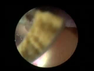 Stones In The Urinary Bladder