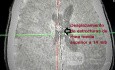 Acute Spontaneous Subdural Hemorrhage in the Subdural Space