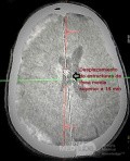 Acute Spontaneous Subdural Hemorrhage in the Subdural Space