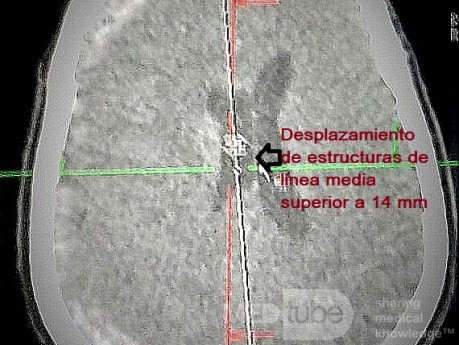 Acute Spontaneous Subdural Hemorrhage in the Subdural Space