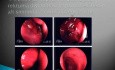 tumor Surgery