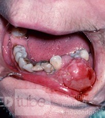 Epulides [fibrous]