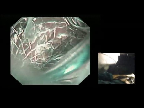 Pseudocyst Drainage 