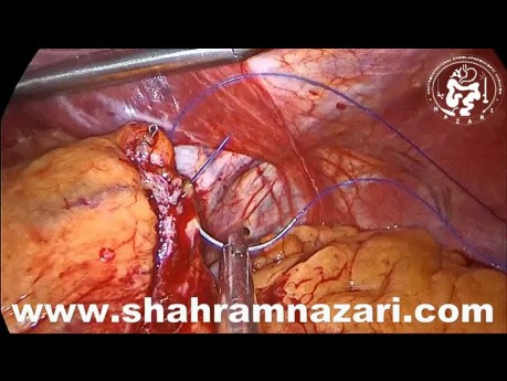 Morbid Obesity Sleeve Gastrectomy