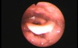 Fishbone Impaction at Lingual Tonsil