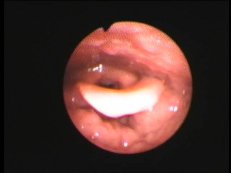 Fishbone Impaction at Lingual Tonsil