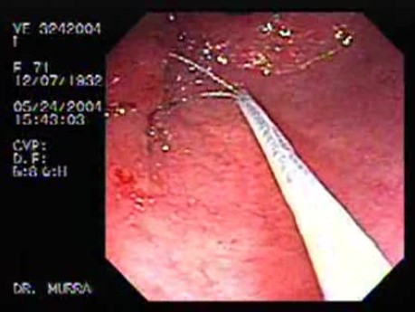 Adenomatous Gastric Polyp - Endoscopy Polypectomy