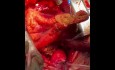 Extensive Resection of Heart Tumor by CPB 