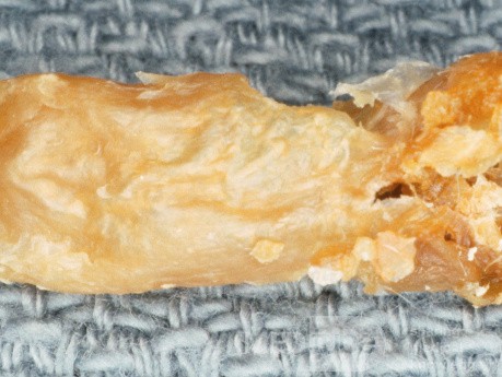 Typical Cast Removed from Chronic Membranous Otitis Externa