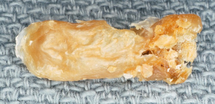Typical Cast Removed from Chronic Membranous Otitis Externa