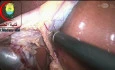 Cystic Artery with Bipolar Diathermy