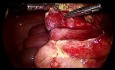 Laparoscopic Appendicectomy for Gangrenous Appendix