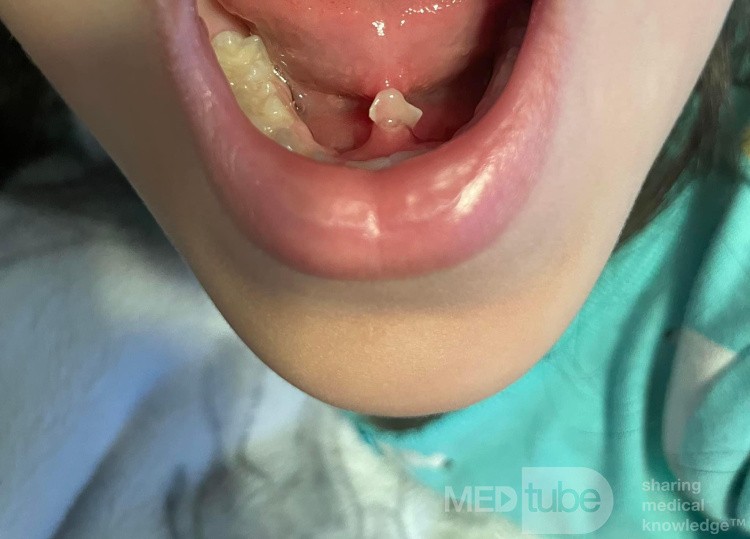 Submandibular Gland Stone In a Child