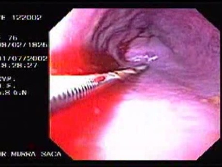 Hemorrhage Due Status Post Rubber Band Ligation of Esophageal Varices - Third Sclerotherapy Applied on Large Vein
