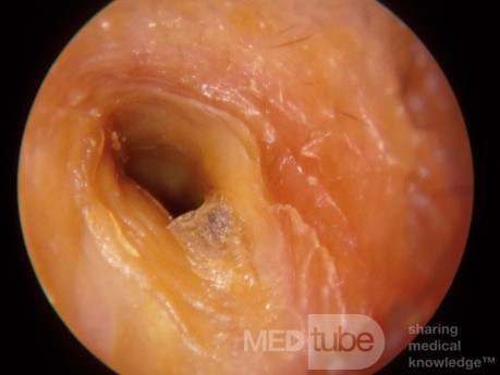 Chronic Membranous Otitis Externa