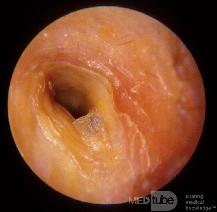 Chronic Membranous Otitis Externa