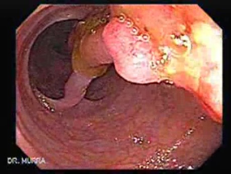 Colonoscopic Polypectomy (4 of 18)