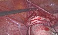 Laparoscopic Cystectomy of Huge Multiloculate Ovarian Cyst