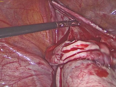 Laparoscopic Cystectomy of Huge Multiloculate Ovarian Cyst