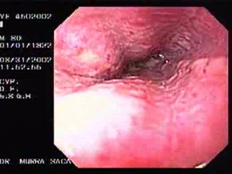 Hemorrhagic Esophagitis Due To Alcoholism - Mucosal Ulceration