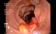 The Odd One Out - Serrated Polyposis Syndrome