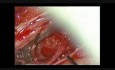 Spinal Meningioma - Microsurgical Removal