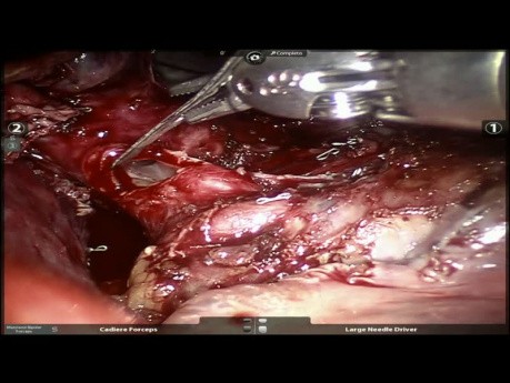 Carcinoid Tumor of the Right Lower Lobe