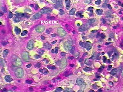 Histoplasmosis of the Colon and Condyloma Accuminata (8 of 11)