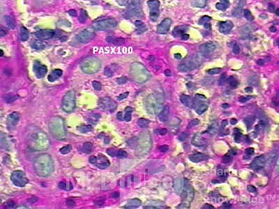 Histoplasmosis of the Colon and Condyloma Accuminata (8 of 11)