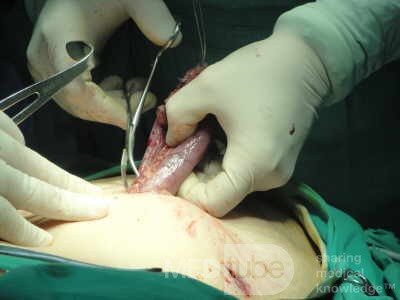 Gastric Ulcerated Adenocarcinoma of the Pre-pyloric Antrum (15 of 28)