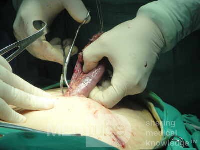 Gastric Ulcerated Adenocarcinoma of the Pre-pyloric Antrum (15 of 28)