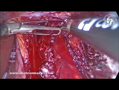Heller's Myotomy and Methylene Blue Test in Achalasia