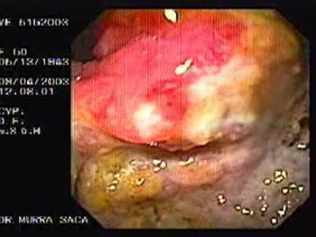 Extensive Neoplasia (2 of 4)