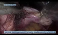 Vaginal Salpingo Oophorectomy Made Easy by vNOTES Natural Orifice Surgery