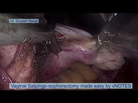 Vaginal Salpingo Oophorectomy Made Easy by vNOTES Natural Orifice Surgery