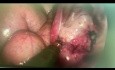 Tubal Latency Blue Test During a VNOTES Ovarian Cystectomy 