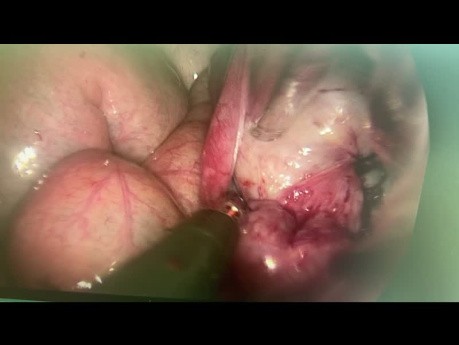 Tubal Latency Blue Test During a VNOTES Ovarian Cystectomy 