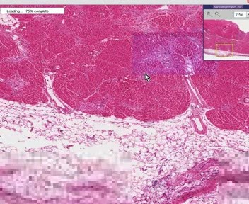Heart - Mural Thrombus - Infarct