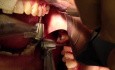 Maxillary Implant Placement - No Surgical Guide - Part 1