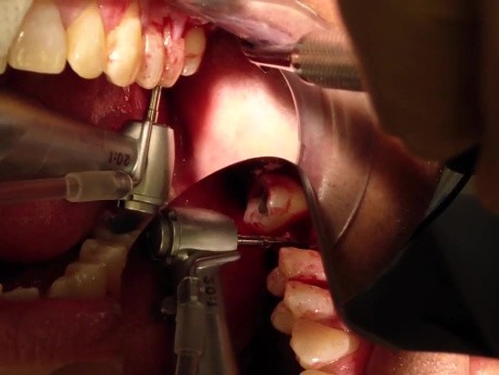 Maxillary Implant Placement - No Surgical Guide - Part 1