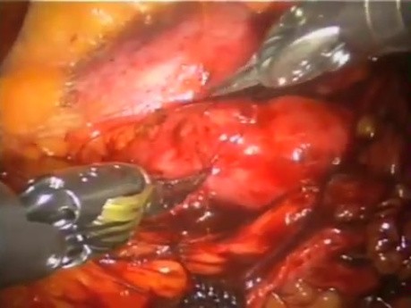 Robotic Ureterolithotomy with Flexible Pyeloscopy for Stone Clearance