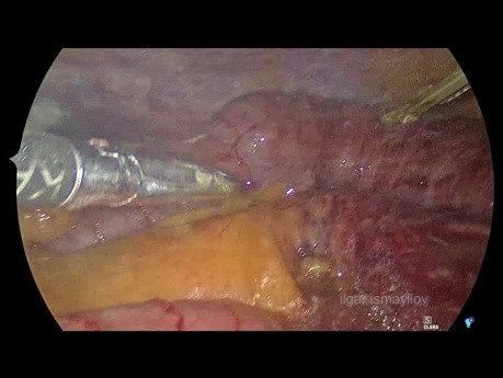 Minimally İnvasive Management of Strangulated TransOmental Hernia