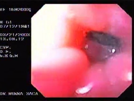 Banding of esophageal varices (7 of 17)