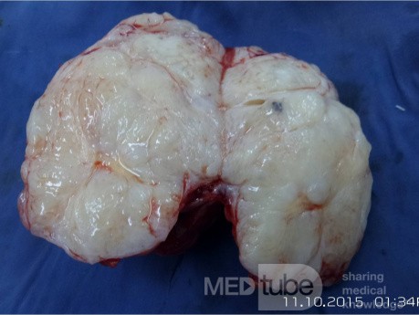 Breast Giant Fibroadenoma 