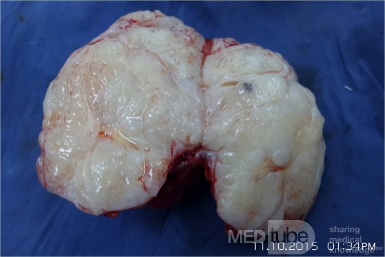 Breast Giant Fibroadenoma 