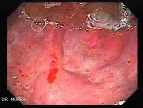 Severe Bleeding after Biopsies (1 of 7)