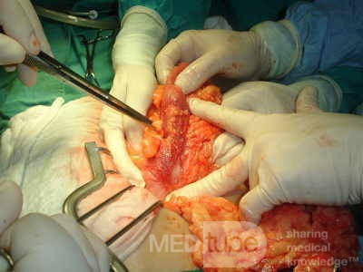 Adenocarcinoma of the Transverse Colon (11 of 15)