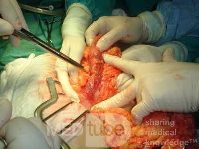 Adenocarcinoma of the Transverse Colon (11 of 15)