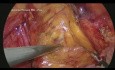 Laparoscopic Inguinal Hernia Repair