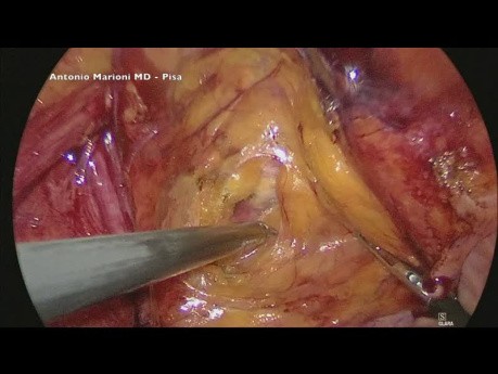 Laparoscopic Inguinal Hernia Repair